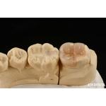 Easy Clean Emax Inlays And Onlays Hypoallergenic Biocompatible Dental Restorations