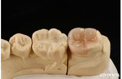 China Easy Clean Emax Inlays And Onlays Hypoallergenic Biocompatible Dental Restorations supplier