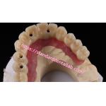 Multi Layer Zirconia Screw Retained Implant Bridge Biocompatible On Metal Structure for sale