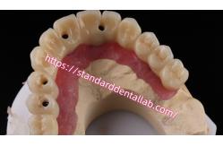 China Multi Layer Zirconia Screw Retained Implant Bridge Biocompatible On Metal Structure supplier