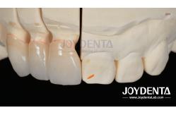 China Painless Procedure BOPT Dental Technique for Accurate Tooth Preparation supplier