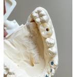 Screw Cement Retained Implant Polished Implants Supported Porcelain Bridge Full Arch for sale