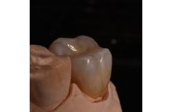 China Full Contour Translucent Zirconia Crown for Aesthetically Pleasing Results supplier