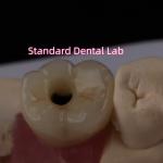 Posterior Implant Crown Bruxier Solid Zirconia Screw Retained for sale