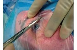 China Eye Ophthalmic Sterile Disposable Surgical Drapes Alcohol Resistant With Two Holes And Pouch supplier