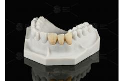 China Durable Hypoallergenic EMAX Bridge Extreme Esthetics Emax Dental Bridge supplier