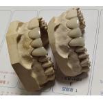 Porcelain CAD CAM PFM Crown
