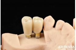 China High Durability White Finish Implant Crown And Bridge With Accurate Fit supplier