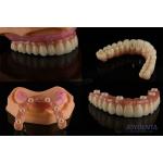 Dental Multiple Teeth Replacement Implants Rough Surface Prosthetic Components for sale