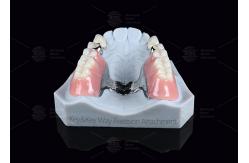 China Silver Key And Keyway Attachment Easy Maintenance Precision Attachment Dental supplier