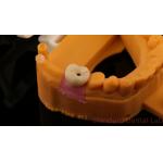 Dental Implant Screw Retained Crown PFZ Porcelain Layered Zirconia With 3D Print Model for sale