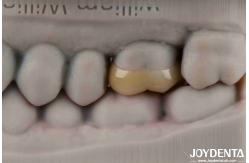 China Medium Translucency Emax Inlay Onlay Easy Cleaning And Non-toxic Biocompatibility In Materials supplier