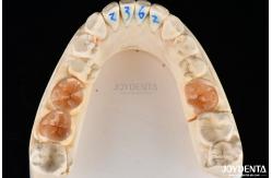 China Customizable Shape Composite Inlays And Onlays Dental Stain Resistance Long Lasting supplier