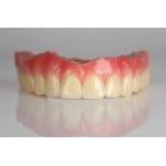 Full Arch Zirconia Implant Bridge All-On-Four / All On Six Dental Implants Fast Recovery for sale