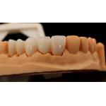 High Aesthetic Anterior Teeth Full Contour Zirconia Crown with Customized Vita Shade Dental Lab for sale
