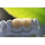 All Ceramic EMAX Porcelain Crown for sale