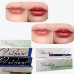 2*1ml/Box Cross Linked Dermal Filler For Lips Augmentation