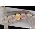 Fracture Toughness 9 MPa·m1/2 High Aesthetics High Resistance To Wear Full Zirconia for sale