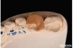China Zirconia Inlay Onlay With Adhesive Cementation For Damaged Teeth Restoration supplier