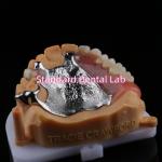 China Upper Cast Framework Acrylic Metal Partial Dentures Strong Lightweight and Durable manufacturer