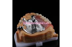 China Upper Cast Framework Acrylic Metal Partial Dentures Strong Lightweight and Durable supplier