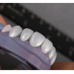 Natural looking Emax Veneers Crown Biocompatibility Bleaching Shade with Minimal Preparation for sale