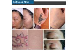 China Vertical Beauty Picosecond Laser Machine Pigmentation Removal Laser Machine supplier