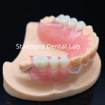 High Esthetics Acrylic Partial Denture With Clear Clasp And Acrylic Teeth China Dental Lab for sale