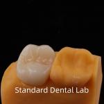 5-Year Guarantee Full Contour Zirconia Crown for Molar Teeth Noritake Porcelain Made in by Trusted Dental Laboratory for sale