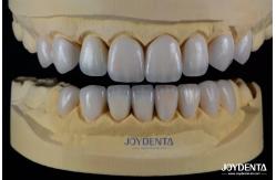 China Advanced Ceramic Porcelain Veneers Biocompatible Shade Matched for a Natural Smile supplier