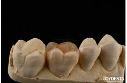 China Custom Compound Inlay Onlay For Minimally Invasive Dental Restoration supplier