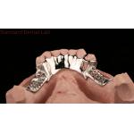 Cobalt Chrome Cast Metal Framework Partial Dentures With Lower Apron Design SDL Dental Lab for sale