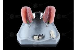China Silver Key And Keyway Attachment Easy Maintenance Precision Attachment Dental supplier