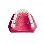 Experience Effective Crossbite Palatal Expansion with CCC Certified Quad Helix Orthodontic Appliance
