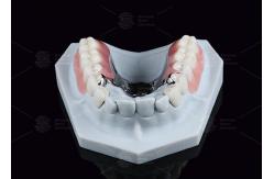 China Silver Key And Keyway Attachment Easy Maintenance Precision Attachment Dental supplier