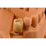 Internal Hex Connection Sandblasted Titanium Dental Implants Single Tooth Replacement for sale