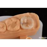 0.5mm-2mm Precise Fit Emax Dental Inlay Onlay For Reliable Tooth Restoration for sale
