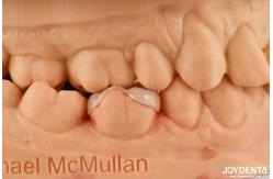 China High Durability Dental Inlay Onlay Composite Natural Looking Appearance supplier