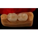 Full Contour Zirconia Crown Exceptional Strength and Esthetics No Porcelian Overlay Posterior Crown China Dental Lab for sale