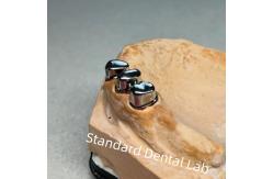 China High Esthetics CAD CAM Tooth Partial Denture Attachment Replacement Standard Dental Lab supplier