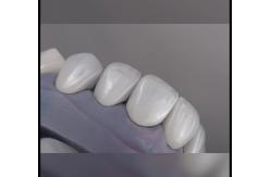 China Natural looking Emax Veneers Crown Biocompatibility Bleaching Shade with Minimal Preparation supplier