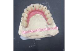 China Malo Bridge Hybrid Zirconia All On Four / Six Zirconia Implant Bridge TItanium Bar supplier