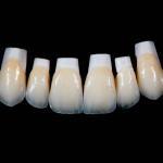 High Translucency Emax Porcelain Veneers Crown with Better Materials by Ivoclar Vivadent for sale