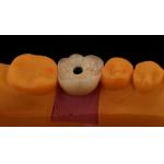 Screw Retained PFZ Porcelain Layered Zirconia Dental Implant Crown from Dental Lab ISO FDA CE Certified with 5-Year Guarantee for sale