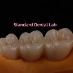 Crown All Porcelain Ceramic Zirconia Ivoclar Esthetic Teeth OEM