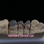 Metal Cast Post Core Crown Cocr Accurate Retentive Full Zirconia Bruxier for sale