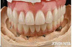 China Good Elasticity Dental Acrylic Denture Finish With Tooth Arrangement Technology supplier