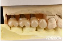 China Ultra-precision processing Zirconia Implants All-Zirconium Integrated Crown supplier