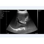 Handheld Portable Bladder Scanner Wireless Connection To Mobilephone Tablet Computer