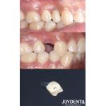 All On 4 Dental Tooth Implant Cylindrical Shape Titan Implant Dental Rough Surface for sale